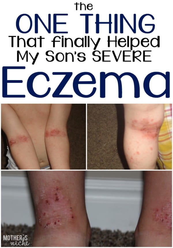 Goodbye Eczema!